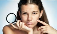 Pimples major issue for Girls